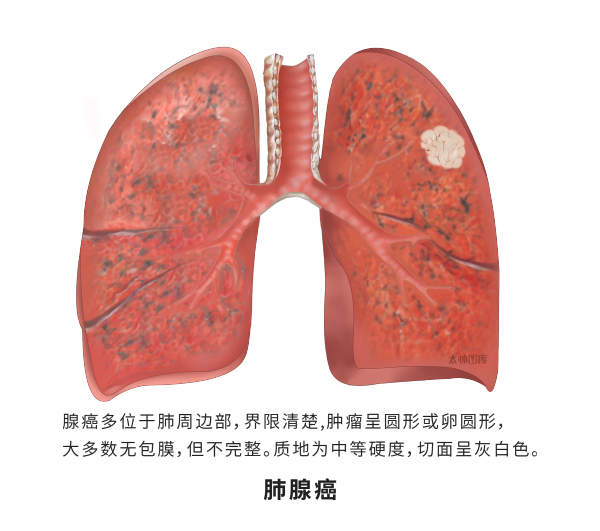 肺癌 医学插画