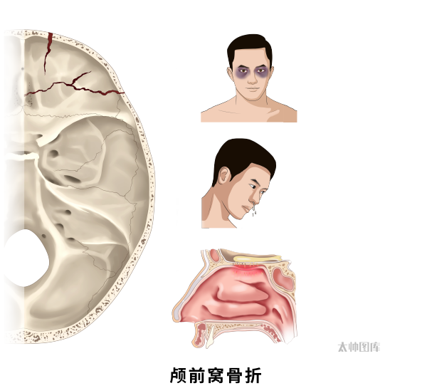颅前窝骨折(标注版) | 医学插画
