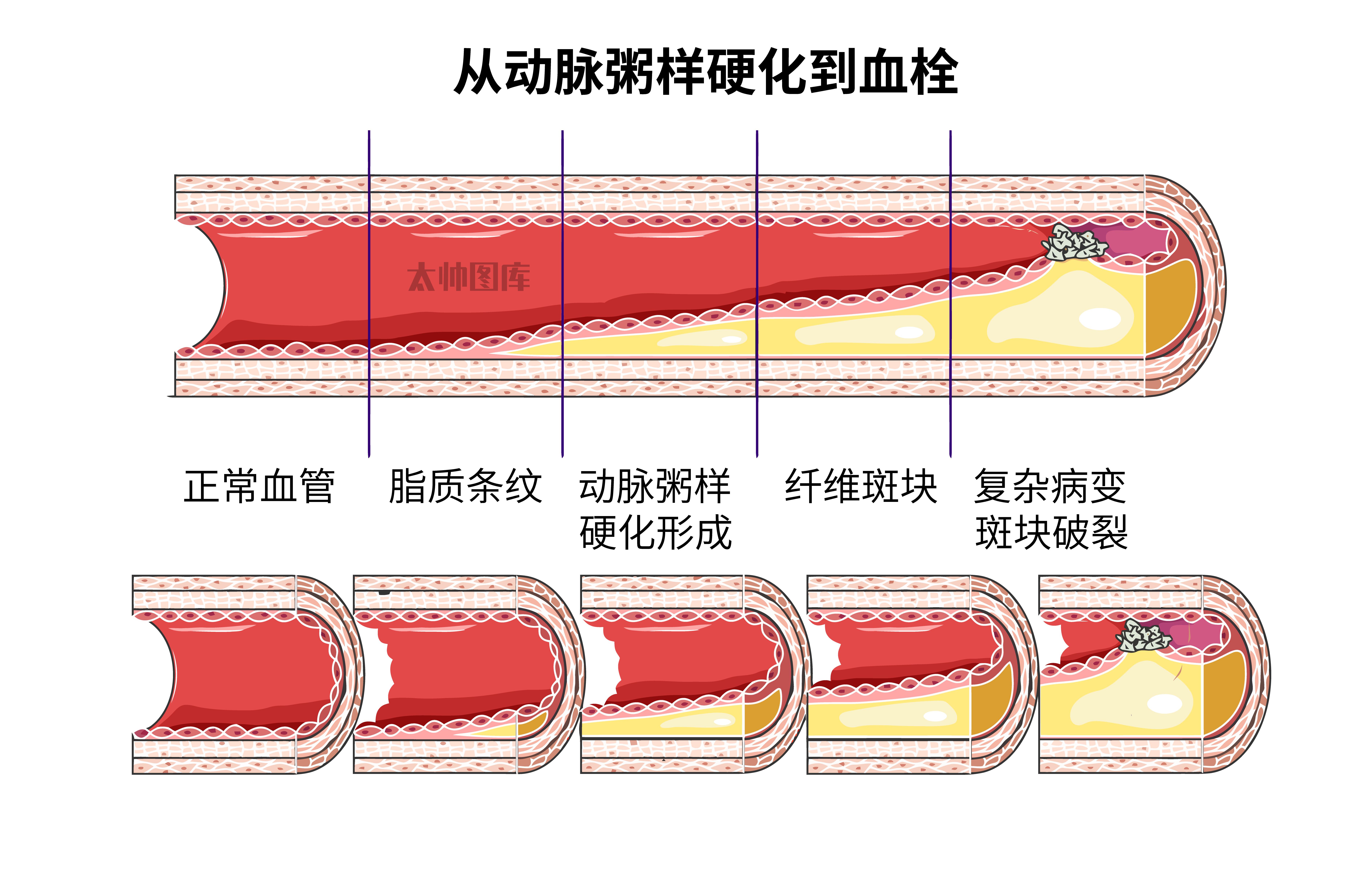 动脉粥样硬化红蓝图图片