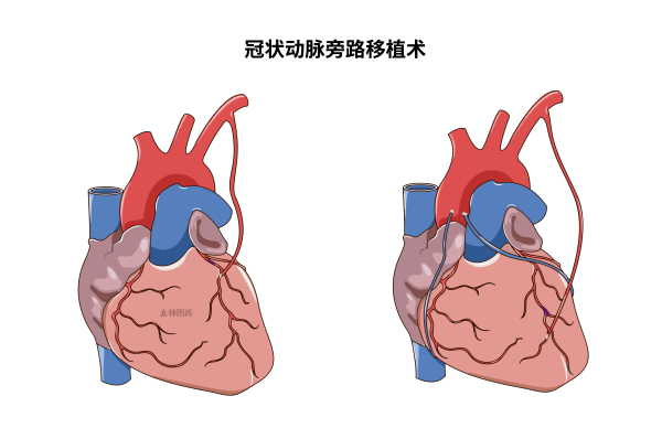 冠状动脉旁路移植术(标注版) | 医学插画