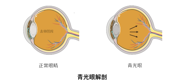 青光眼解剖 | 医学插画