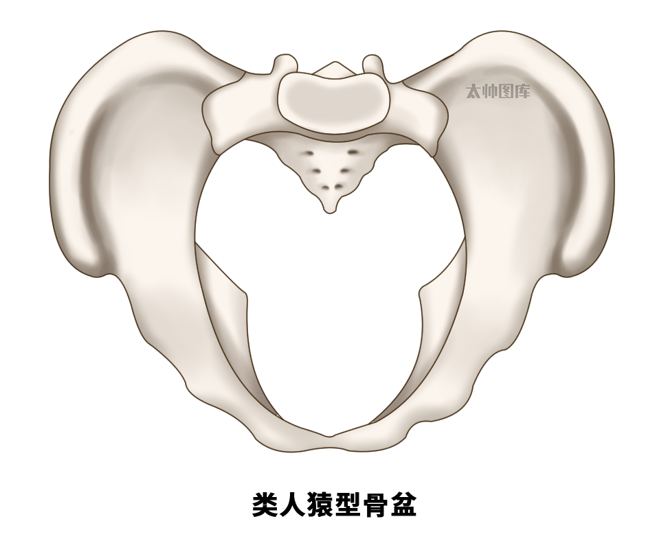扁平型骨盆 